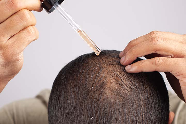 مزايا وعيوب مادة المينوكسيديل لإنبات الشعر